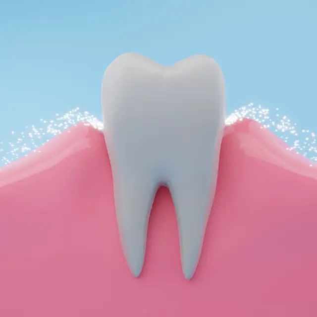 ¿Qué es el sarro dental?